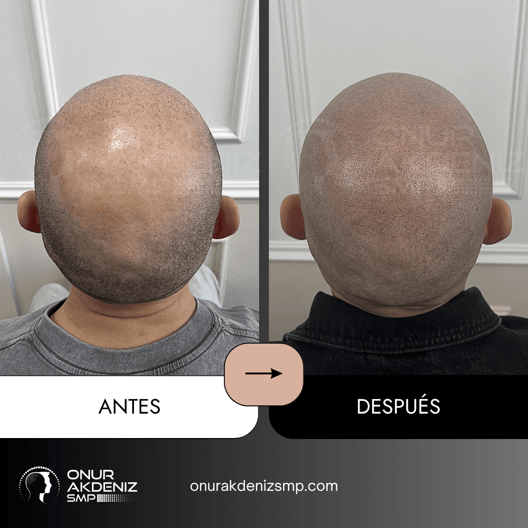 Antes y despues de la micropigmentacion del cuero cabelludo para un aspecto rapado – Onur Akdeniz Estambul Turquia 142