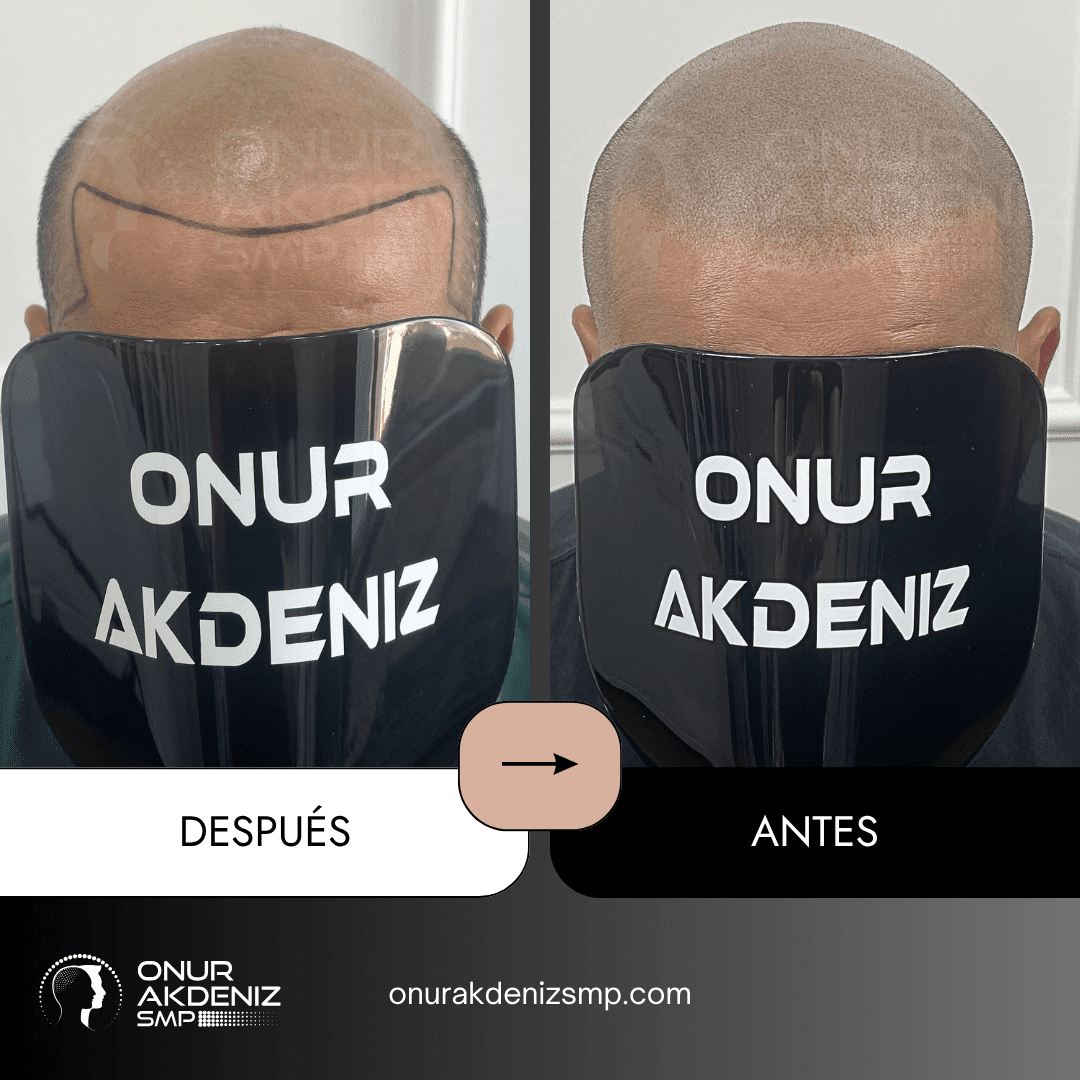 Antes y despues de la micropigmentacion del cuero cabelludo para un aspecto rapado – Onur Akdeniz Estambul Turquia 144