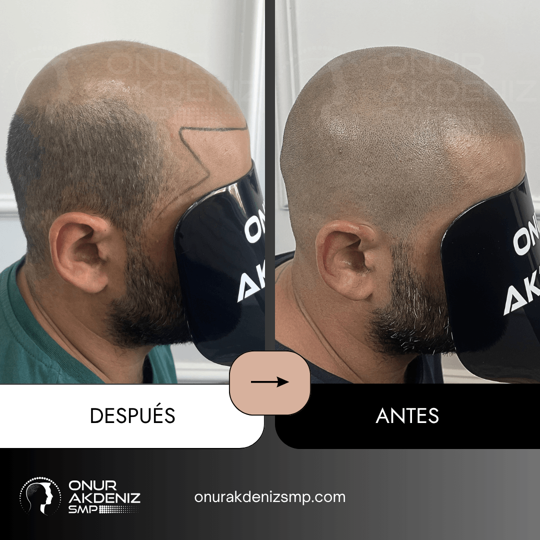 Antes y despues de la micropigmentacion del cuero cabelludo para un aspecto rapado – Onur Akdeniz Estambul Turquia 148