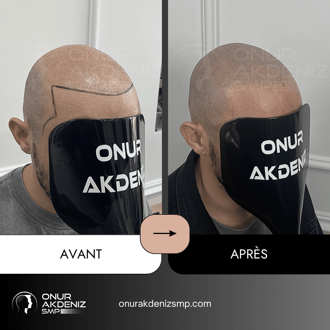 Avant et apres la micropigmentation du cuir chevelu pour un look rase – Onur Akdeniz Istanbul Turquie 138