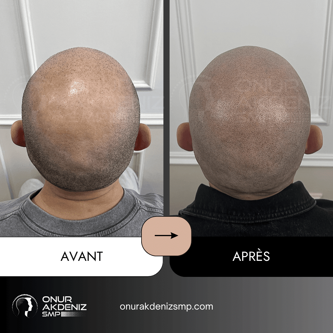 Avant et apres la micropigmentation du cuir chevelu pour un look rase – Onur Akdeniz Istanbul Turquie 142