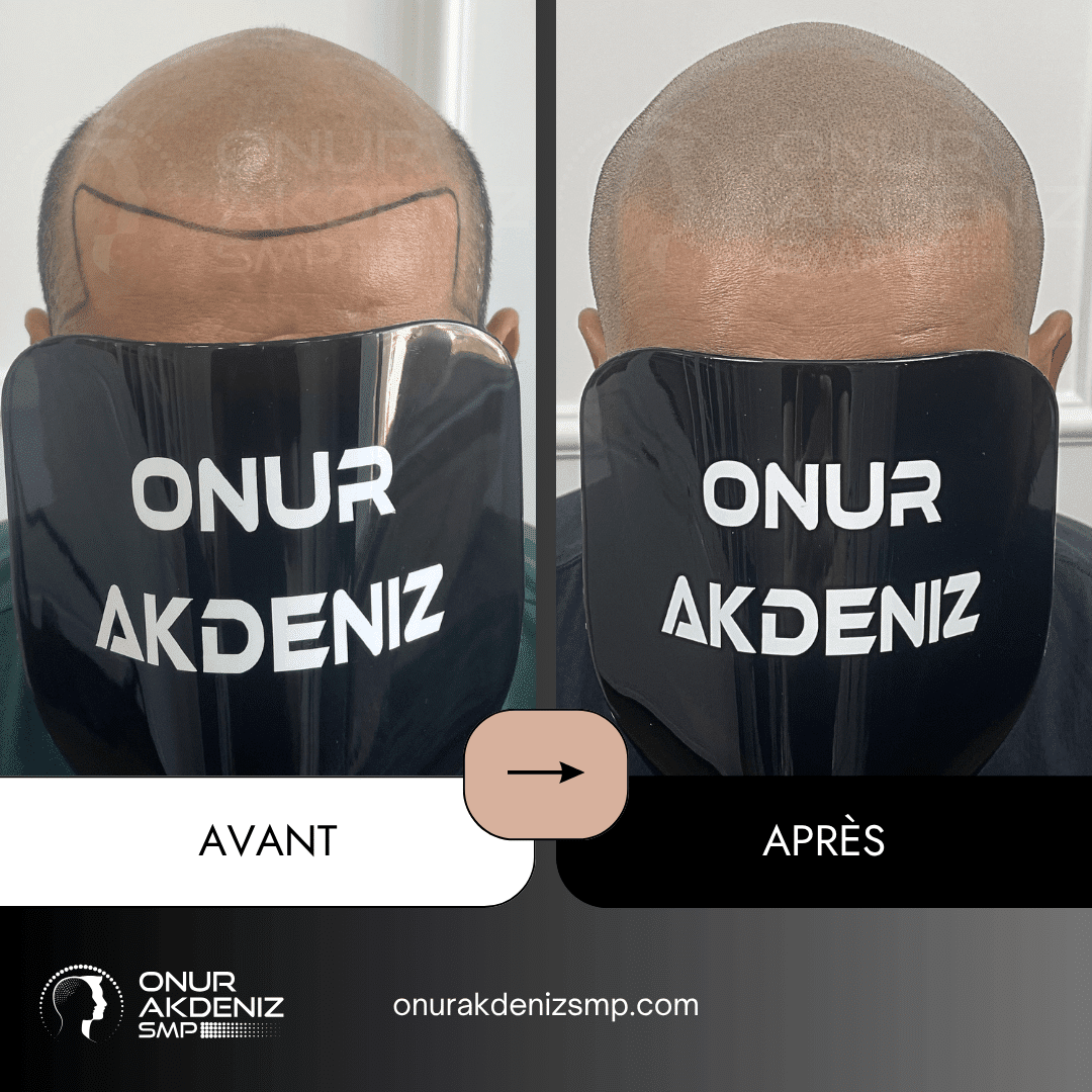 Avant et apres la micropigmentation du cuir chevelu pour un look rase – Onur Akdeniz Istanbul Turquie 144