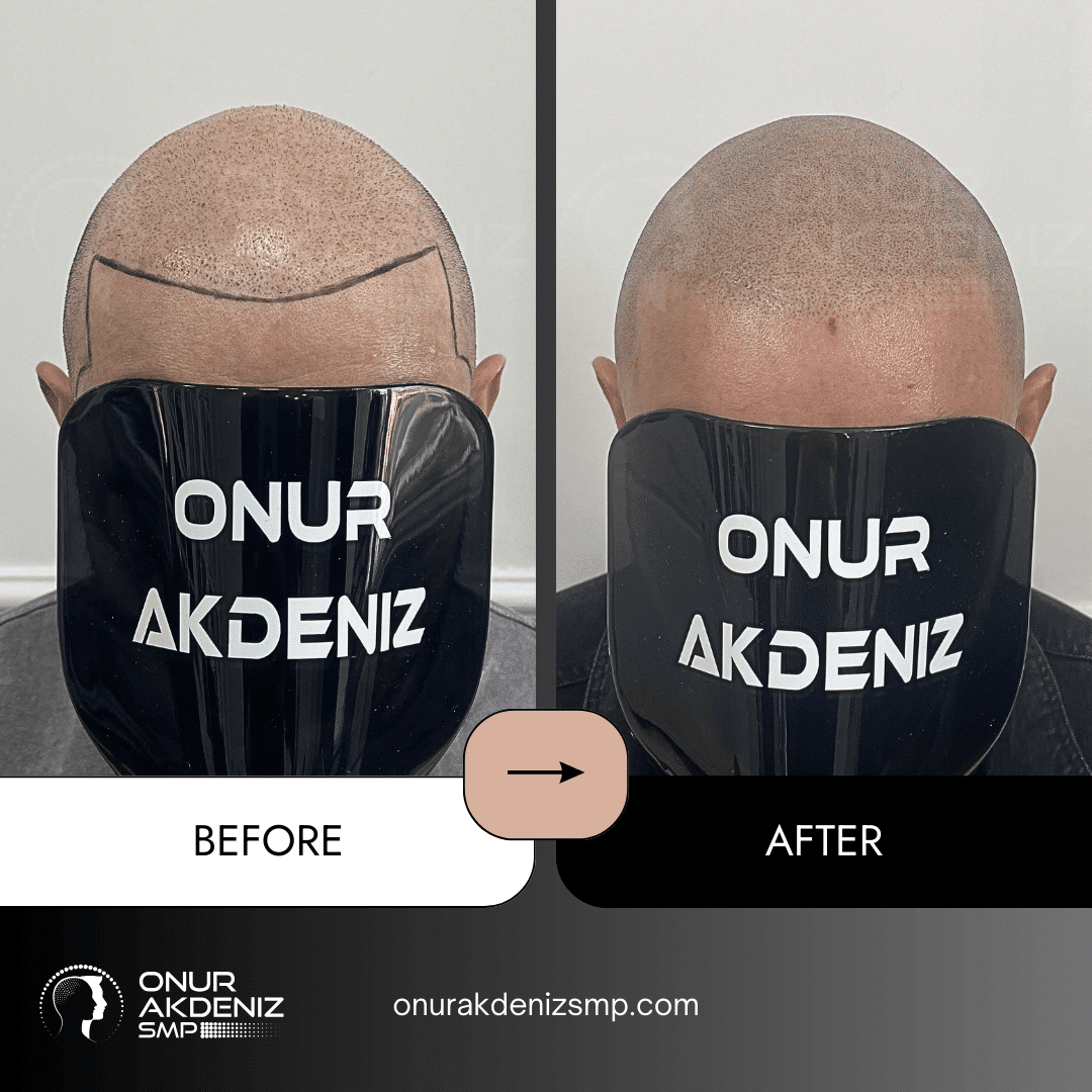 Before and After Scalp Micropigmentation for a Shaved Look Onur Akdeniz SMP Istanbul Turkey 136