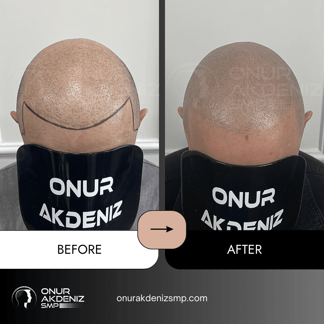 Before and After Scalp Micropigmentation for a Shaved Look Onur Akdeniz SMP Istanbul Turkey 137