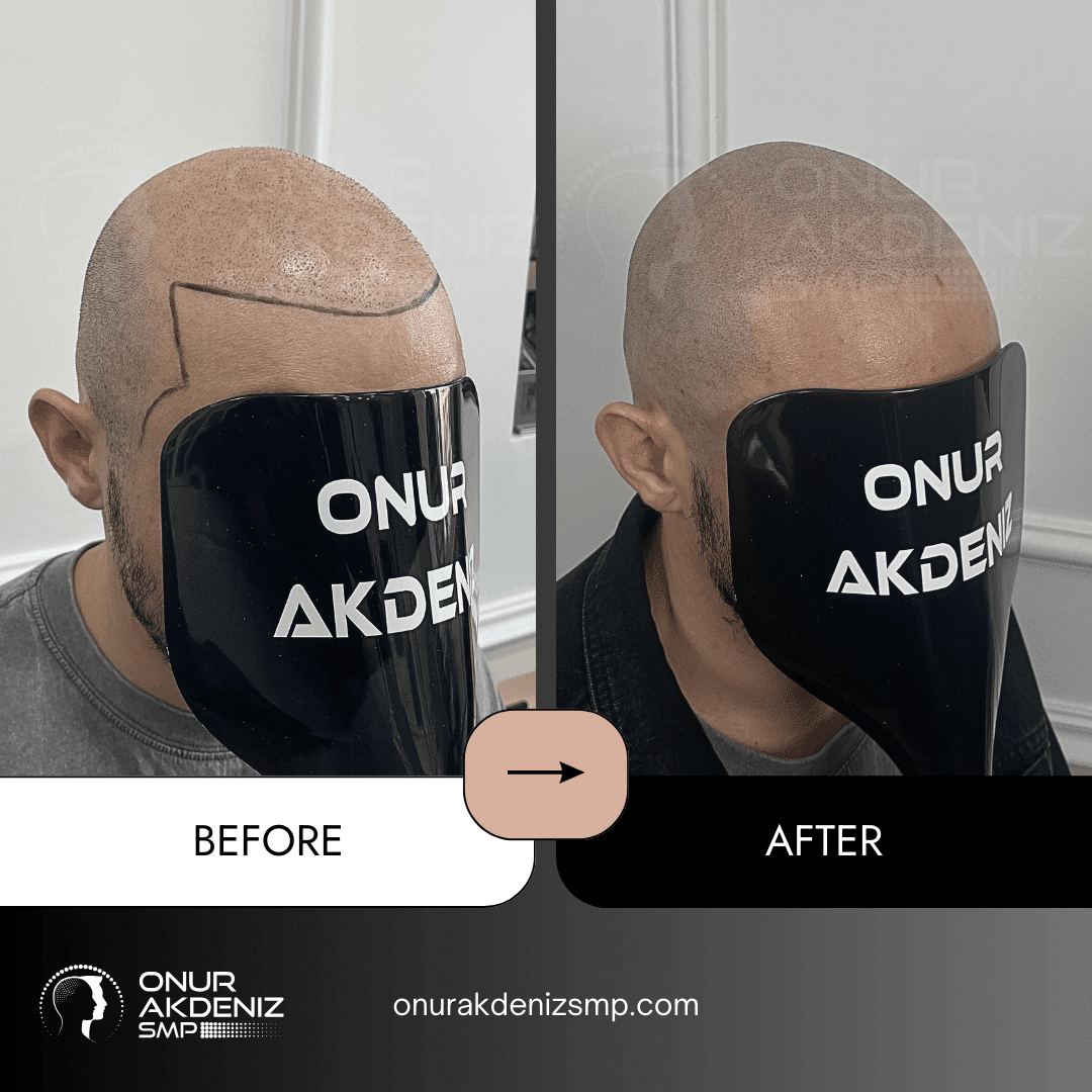 Before and After Scalp Micropigmentation for a Shaved Look Onur Akdeniz SMP Istanbul Turkey 138