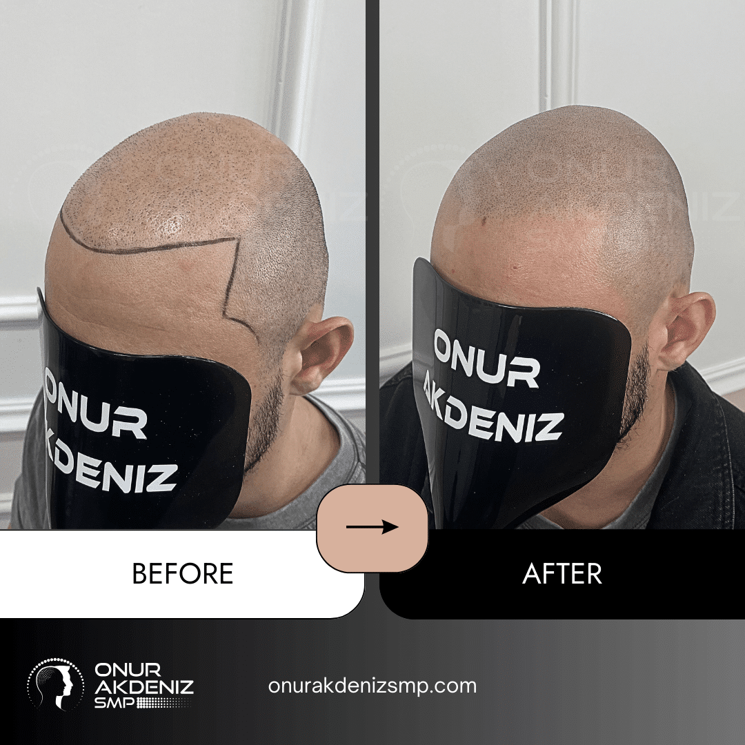 Before and After Scalp Micropigmentation for a Shaved Look Onur Akdeniz SMP Istanbul Turkey 139