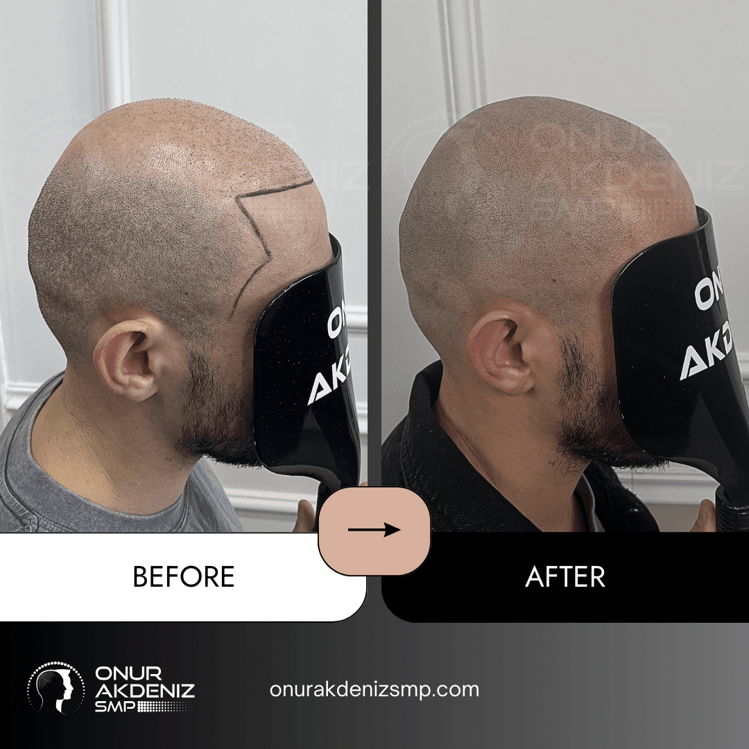 Before and After Scalp Micropigmentation for a Shaved Look Onur Akdeniz SMP Istanbul Turkey 140