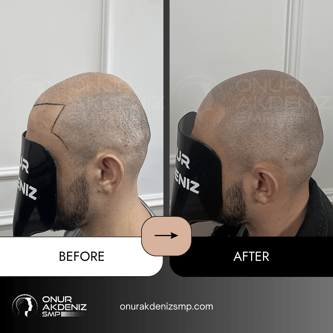 Before and After Scalp Micropigmentation for a Shaved Look Onur Akdeniz SMP Istanbul Turkey 141