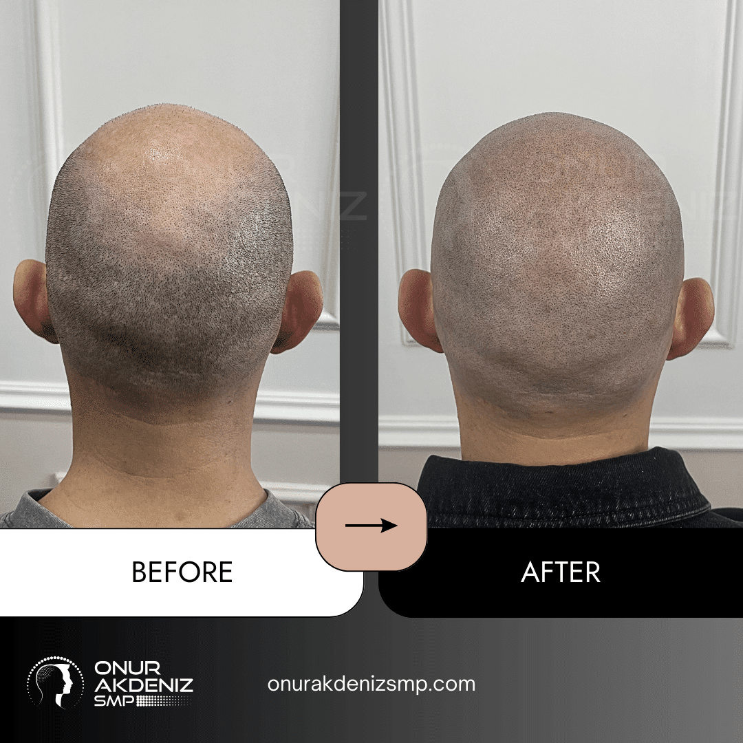 Before and After Scalp Micropigmentation for a Shaved Look Onur Akdeniz SMP Istanbul Turkey 143