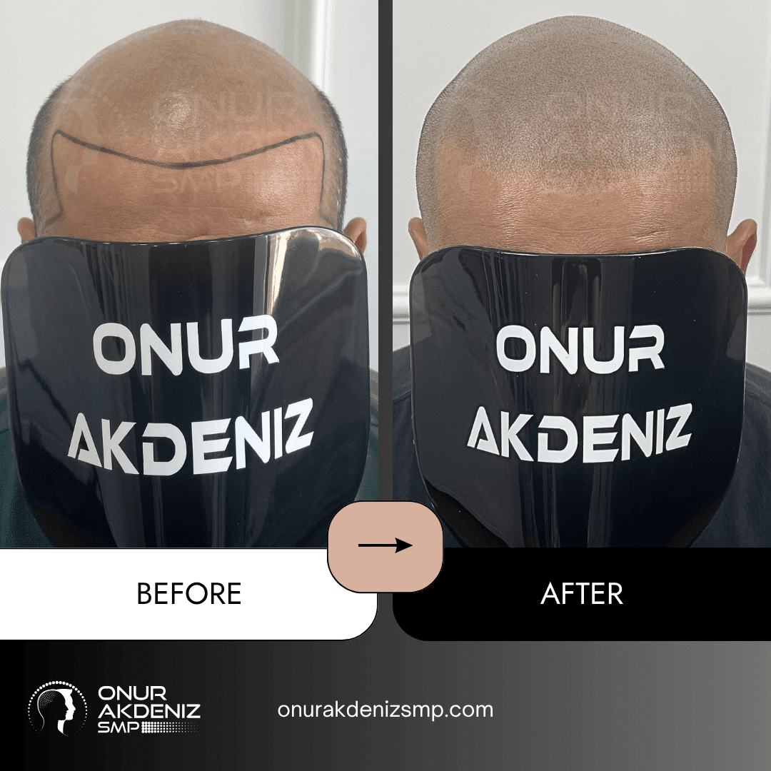 Before and After Scalp Micropigmentation for a Shaved Look Onur Akdeniz SMP Istanbul Turkey 144