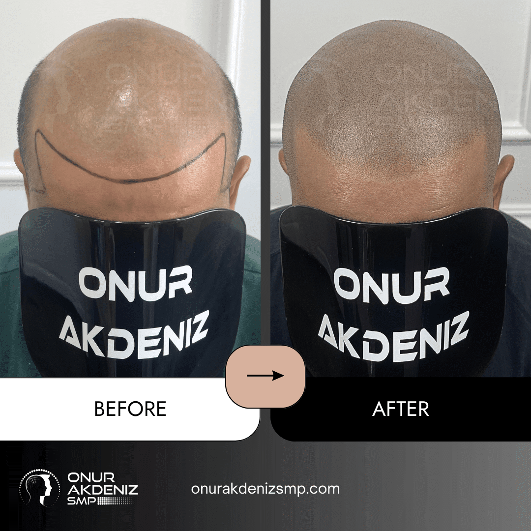 Before and After Scalp Micropigmentation for a Shaved Look Onur Akdeniz SMP Istanbul Turkey 145
