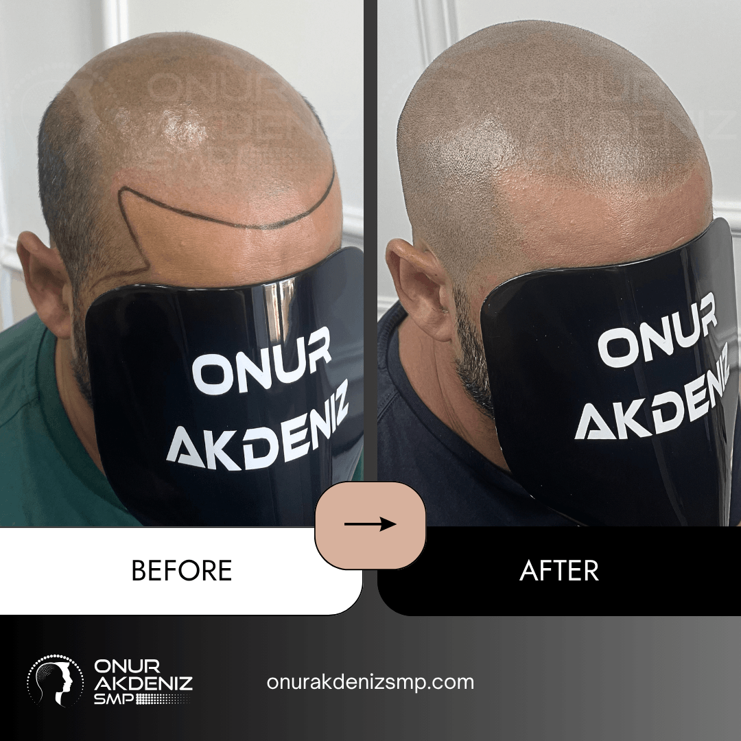 Before and After Scalp Micropigmentation for a Shaved Look Onur Akdeniz SMP Istanbul Turkey 146