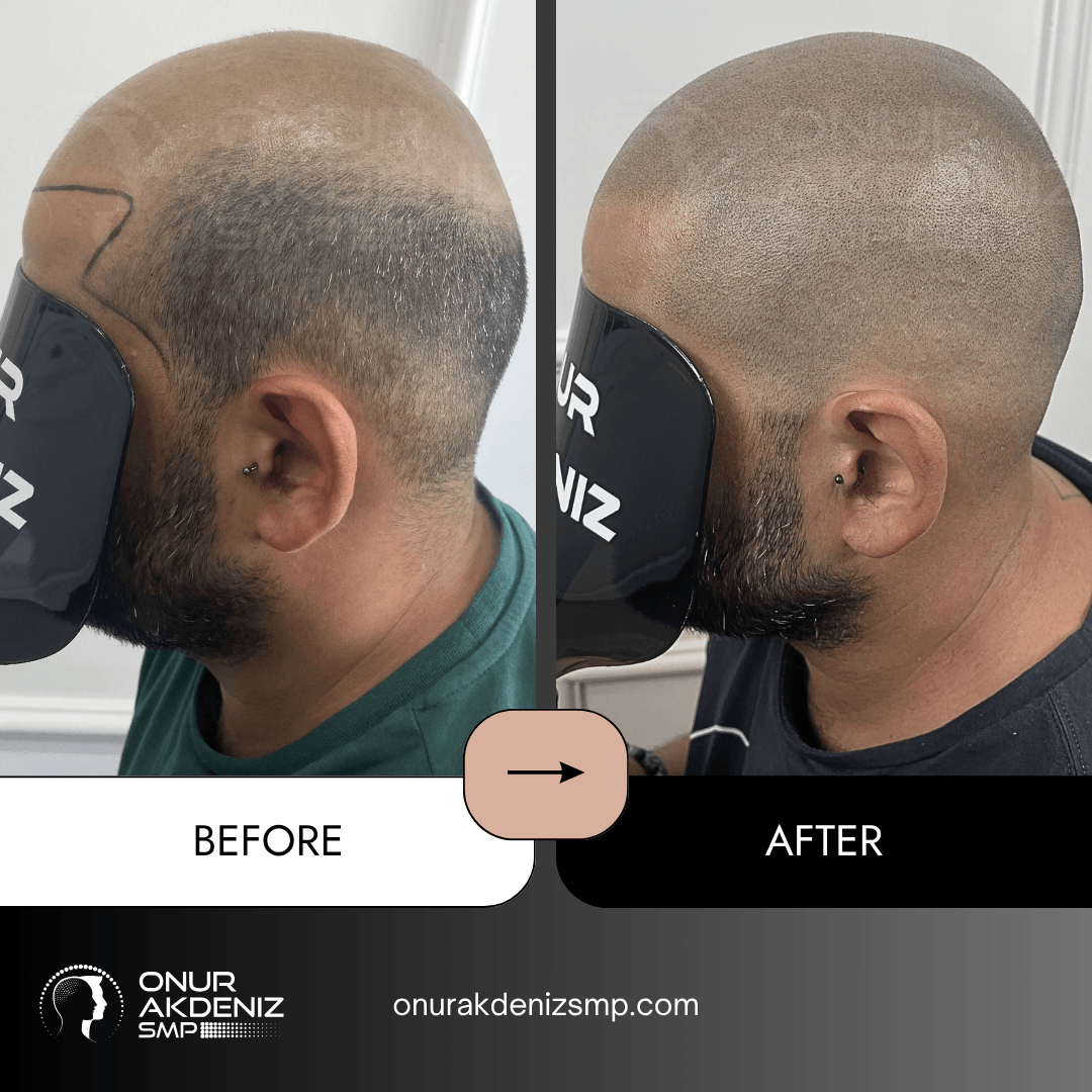 Before and After Scalp Micropigmentation for a Shaved Look Onur Akdeniz SMP Istanbul Turkey 149