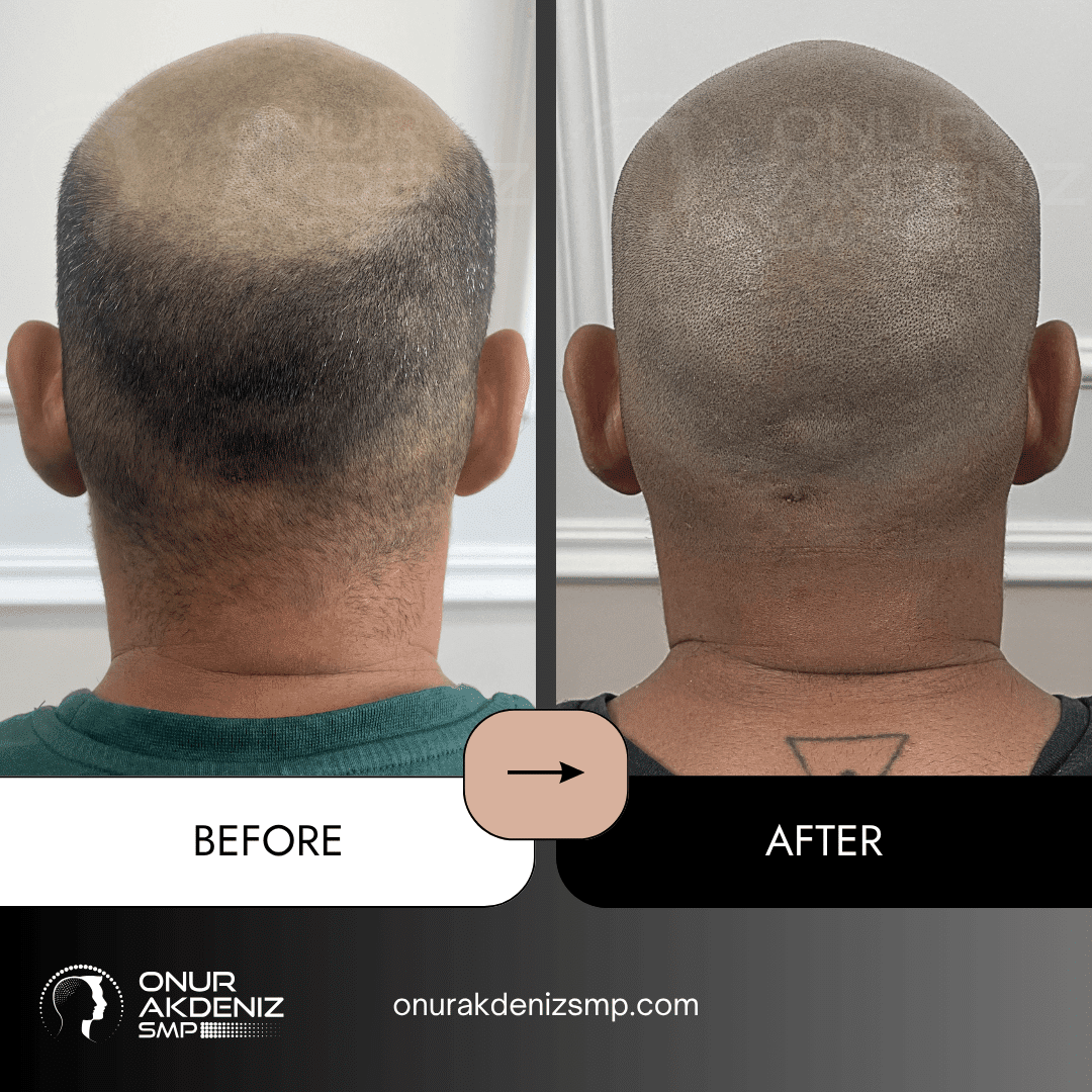 Before and After Scalp Micropigmentation for a Shaved Look Onur Akdeniz SMP Istanbul Turkey 150