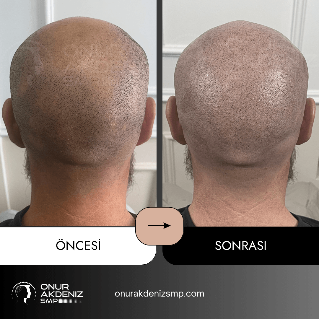 Istanbul Turkiyede Onur Akdeniz SMP ile Alopesi Areata hastalari icin sac mikropigmentasyonu oncesi ve sonrasi 01