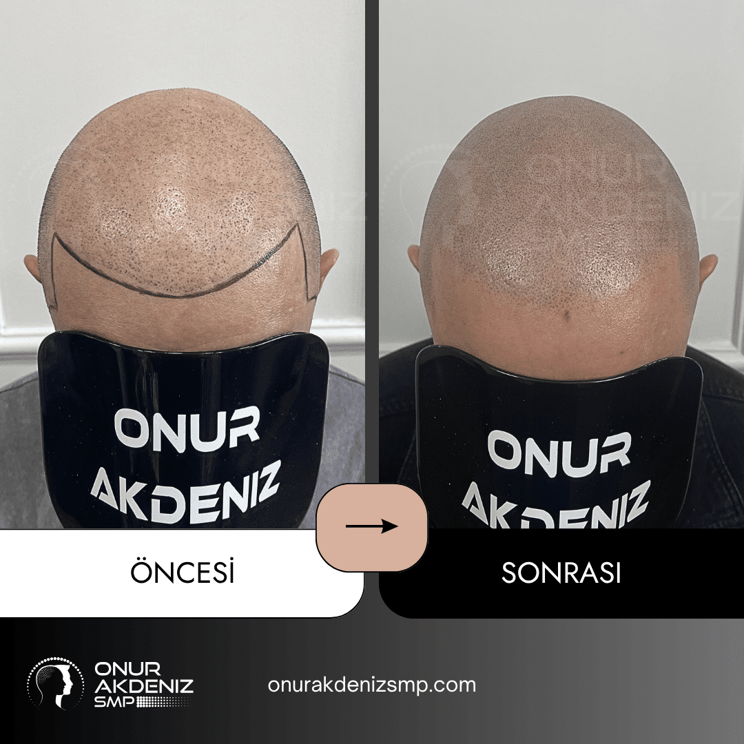 Onur Akdeniz SMP tarafindan tirasli sac gorunumu icin sac mikropigmentasyonu oncesi ve sonrasi 136