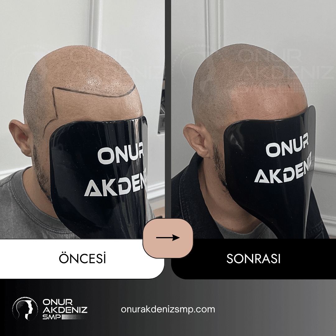 Onur Akdeniz SMP tarafindan tirasli sac gorunumu icin sac mikropigmentasyonu oncesi ve sonrasi 137