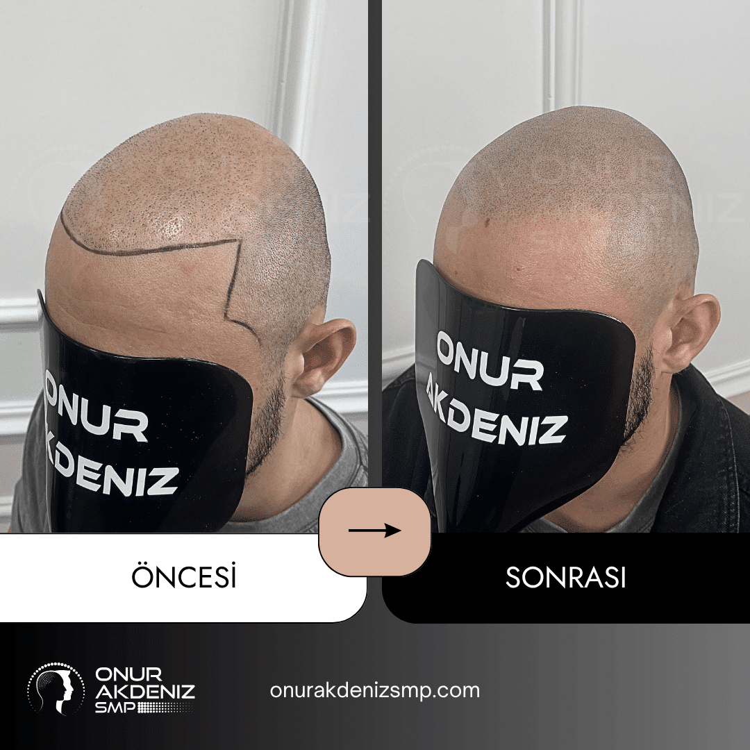 Onur Akdeniz SMP tarafindan tirasli sac gorunumu icin sac mikropigmentasyonu oncesi ve sonrasi 138