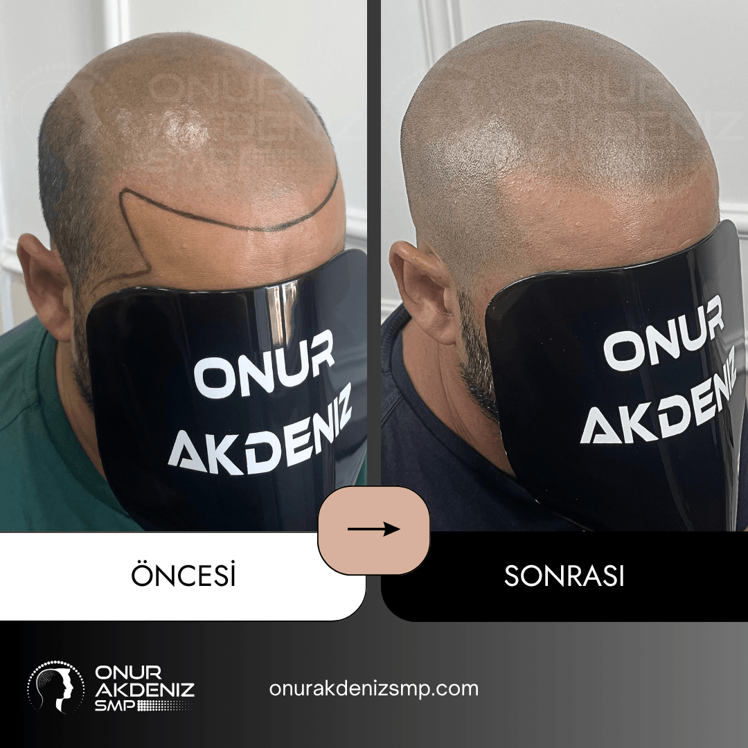 Onur Akdeniz SMP tarafindan tirasli sac gorunumu icin sac mikropigmentasyonu oncesi ve sonrasi 145