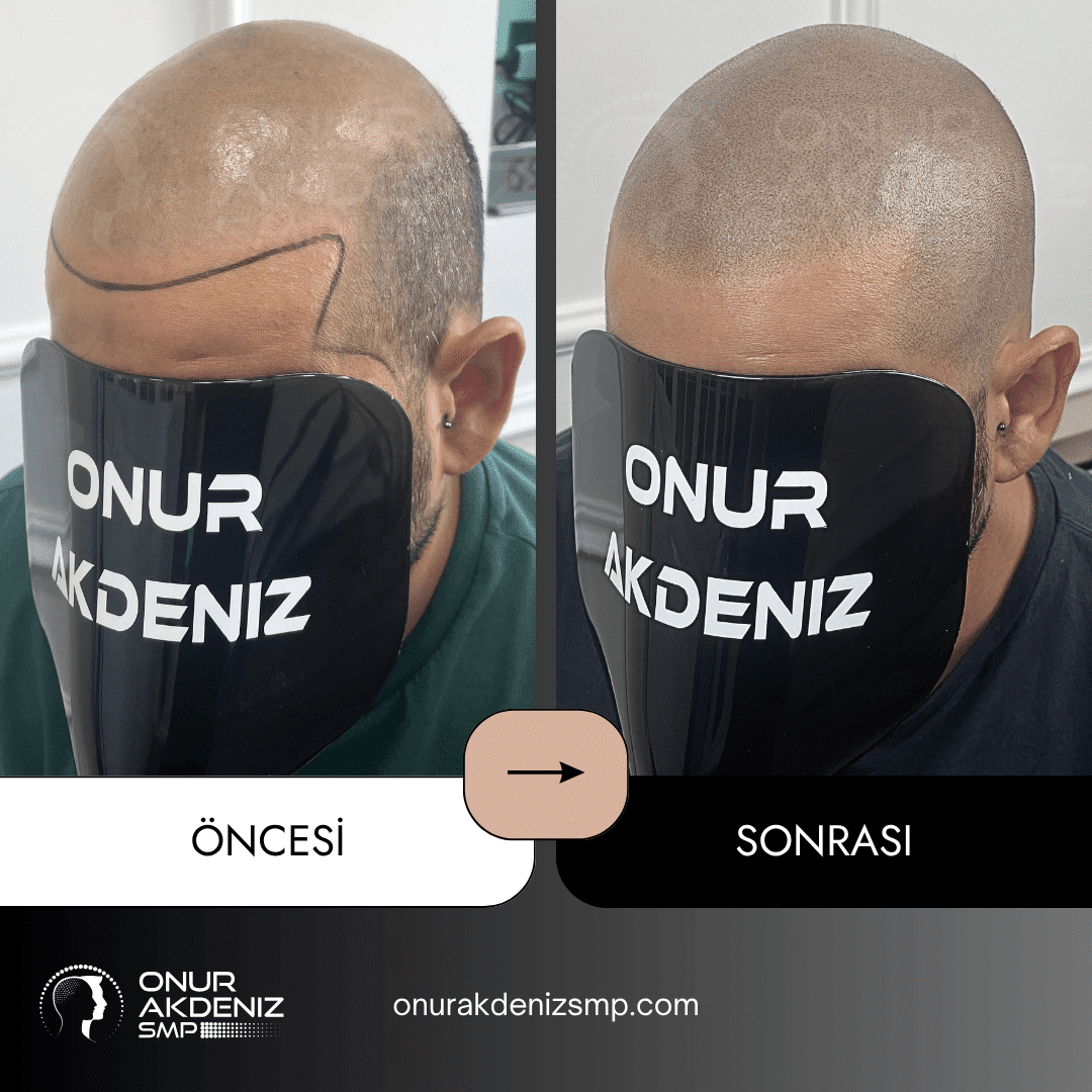 Onur Akdeniz SMP tarafindan tirasli sac gorunumu icin sac mikropigmentasyonu oncesi ve sonrasi 146