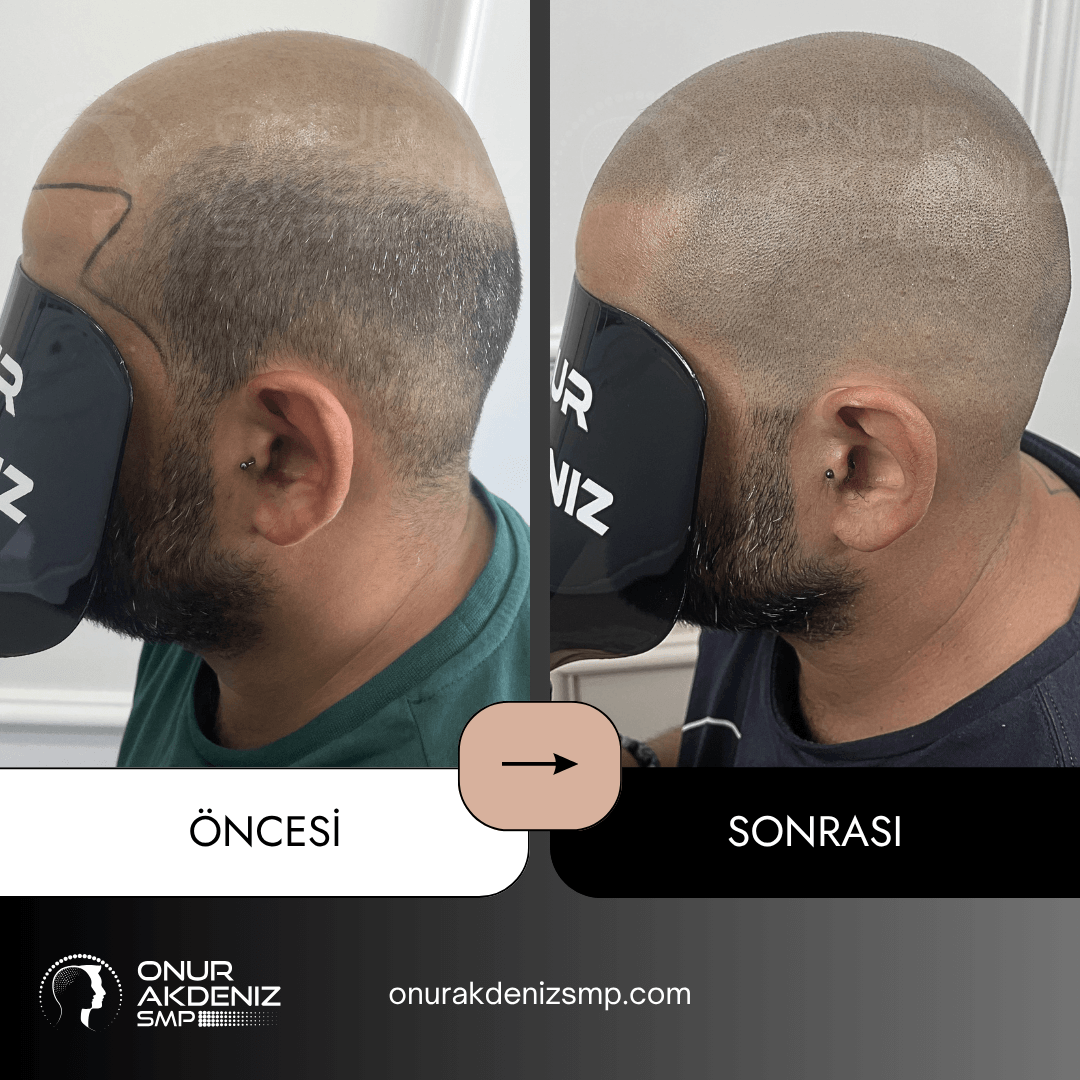 Onur Akdeniz SMP tarafindan tirasli sac gorunumu icin sac mikropigmentasyonu oncesi ve sonrasi 148
