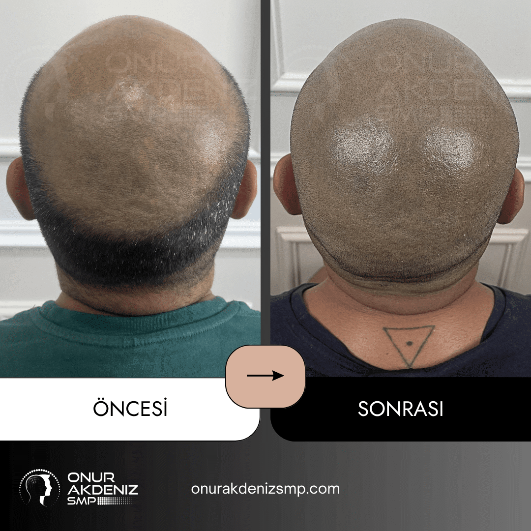 Onur Akdeniz SMP tarafindan tirasli sac gorunumu icin sac mikropigmentasyonu oncesi ve sonrasi 150