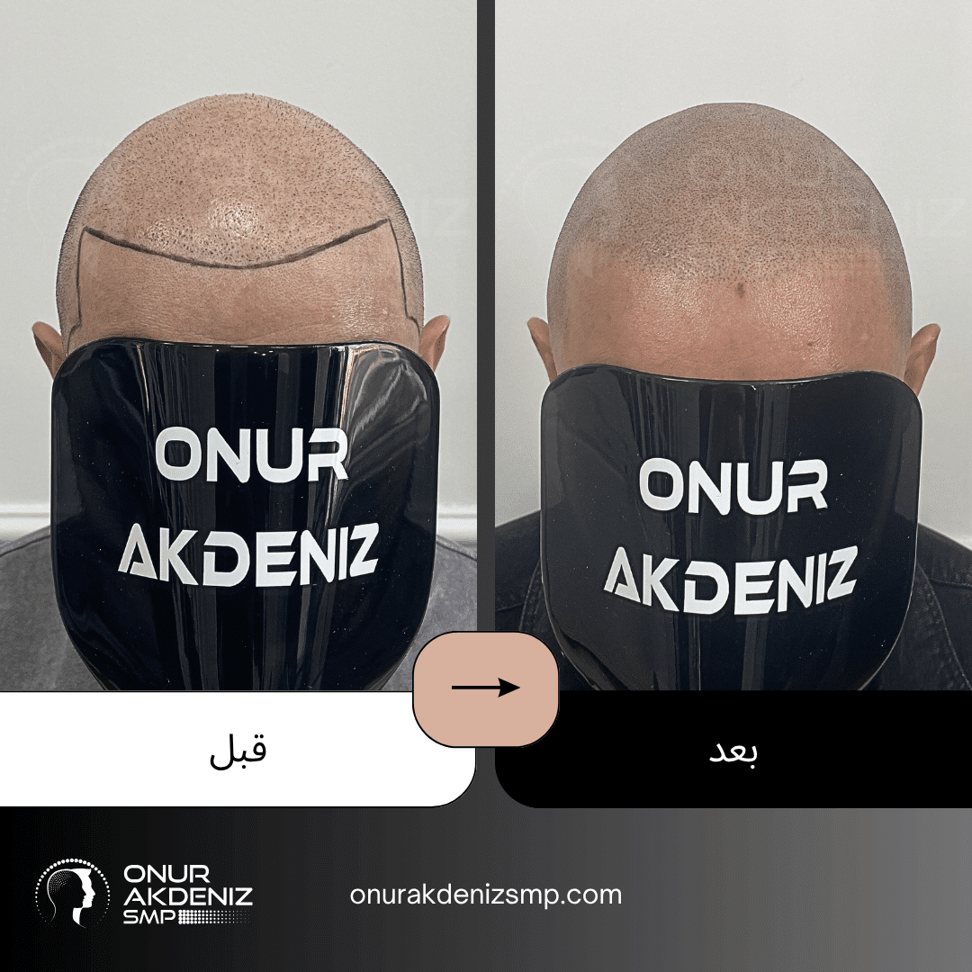 تصبغ فروة الرأس المجهري قبل وبعد للحصول على مظهر الشعر المحلوق مع أونور أكدينيز 135