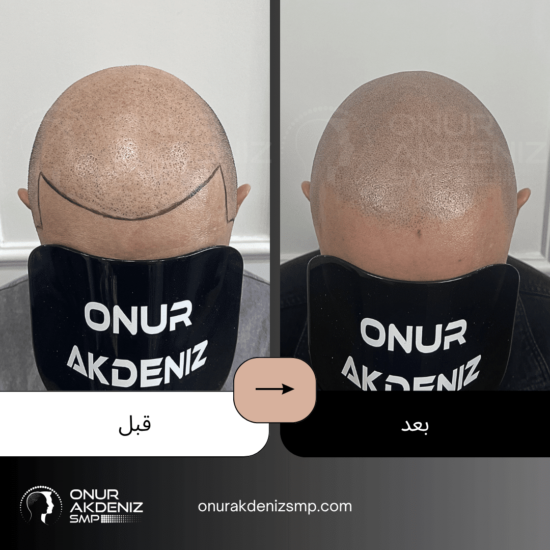 تصبغ فروة الرأس المجهري قبل وبعد للحصول على مظهر الشعر المحلوق مع أونور أكدينيز 136