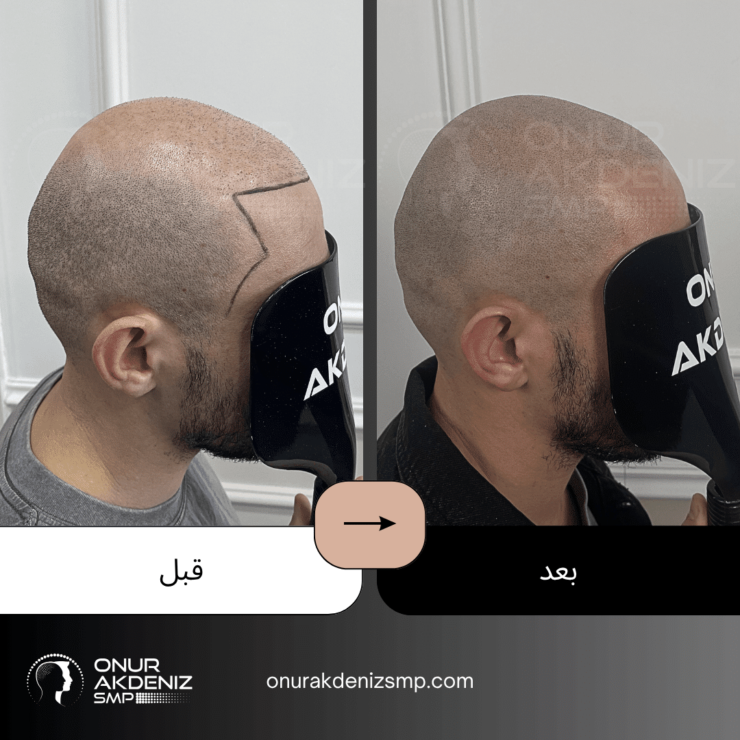 تصبغ فروة الرأس المجهري قبل وبعد للحصول على مظهر الشعر المحلوق مع أونور أكدينيز 139