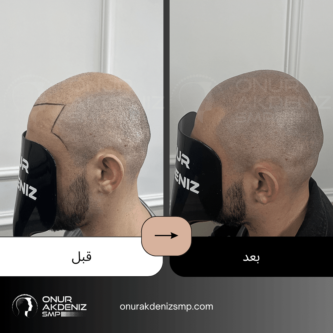 تصبغ فروة الرأس المجهري قبل وبعد للحصول على مظهر الشعر المحلوق مع أونور أكدينيز 140