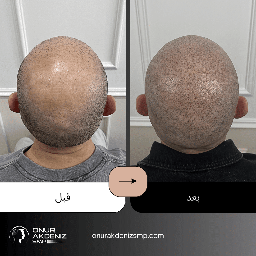 تصبغ فروة الرأس المجهري قبل وبعد للحصول على مظهر الشعر المحلوق مع أونور أكدينيز 141