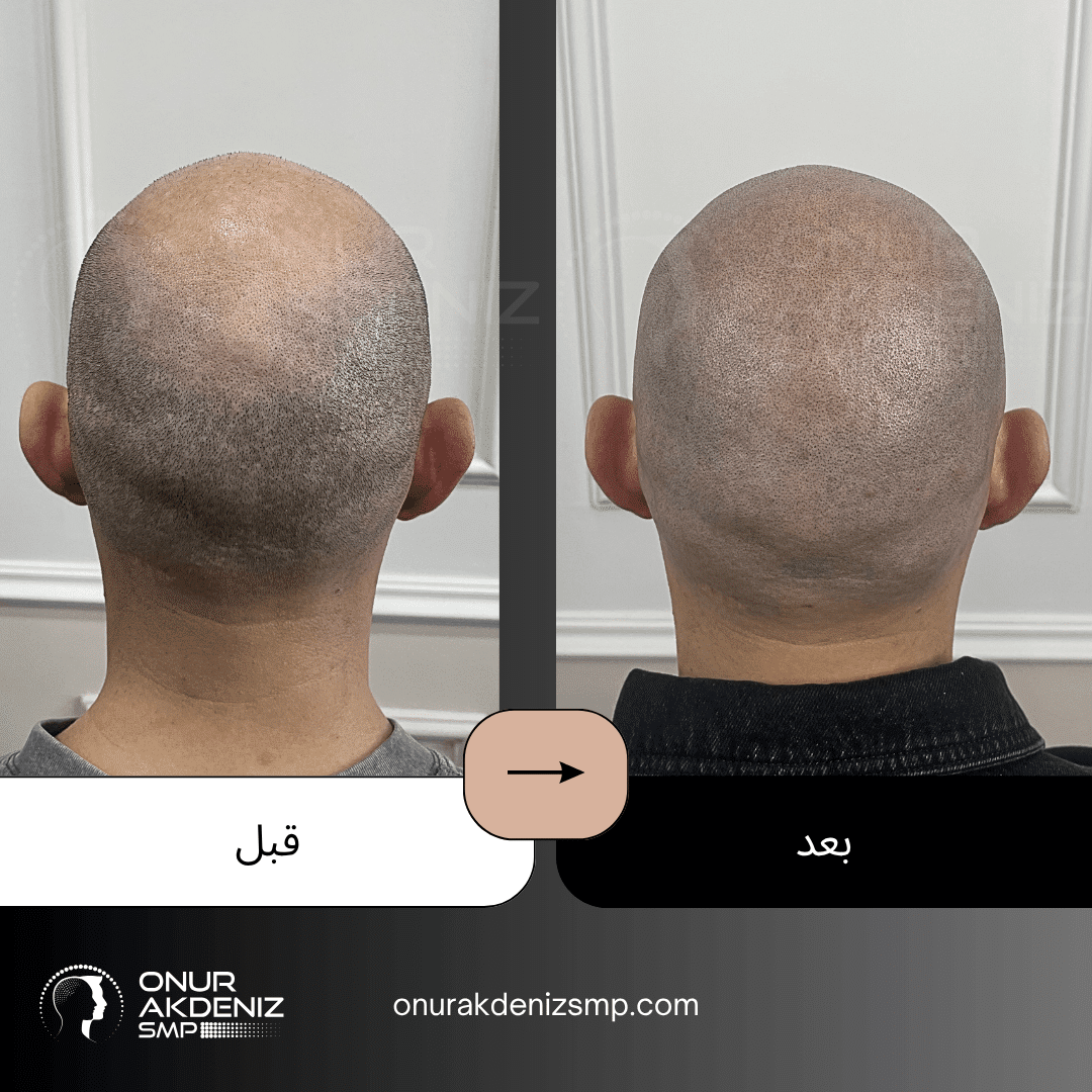 تصبغ فروة الرأس المجهري قبل وبعد للحصول على مظهر الشعر المحلوق مع أونور أكدينيز 142
