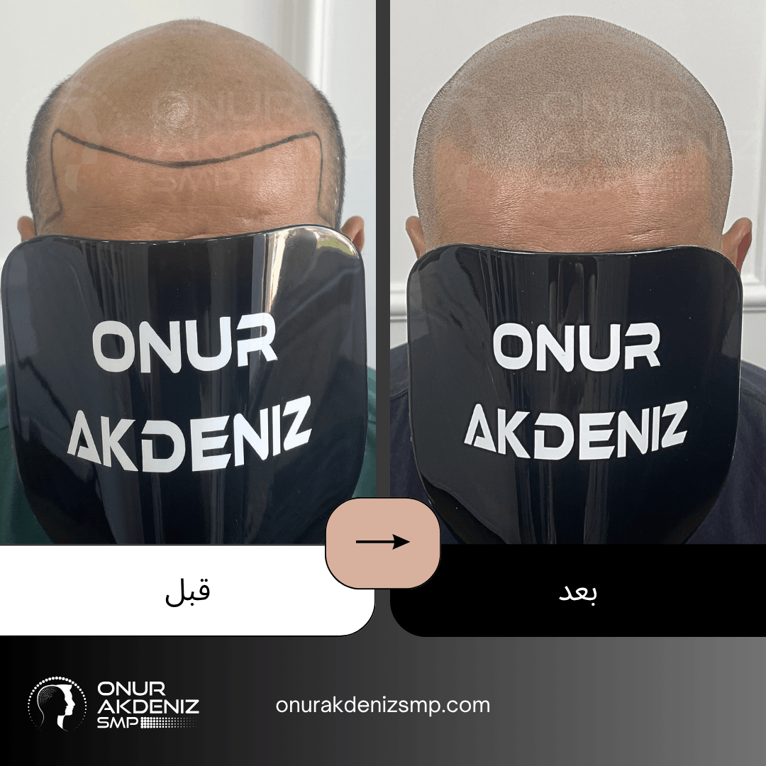 تصبغ فروة الرأس المجهري قبل وبعد للحصول على مظهر الشعر المحلوق مع أونور أكدينيز 143