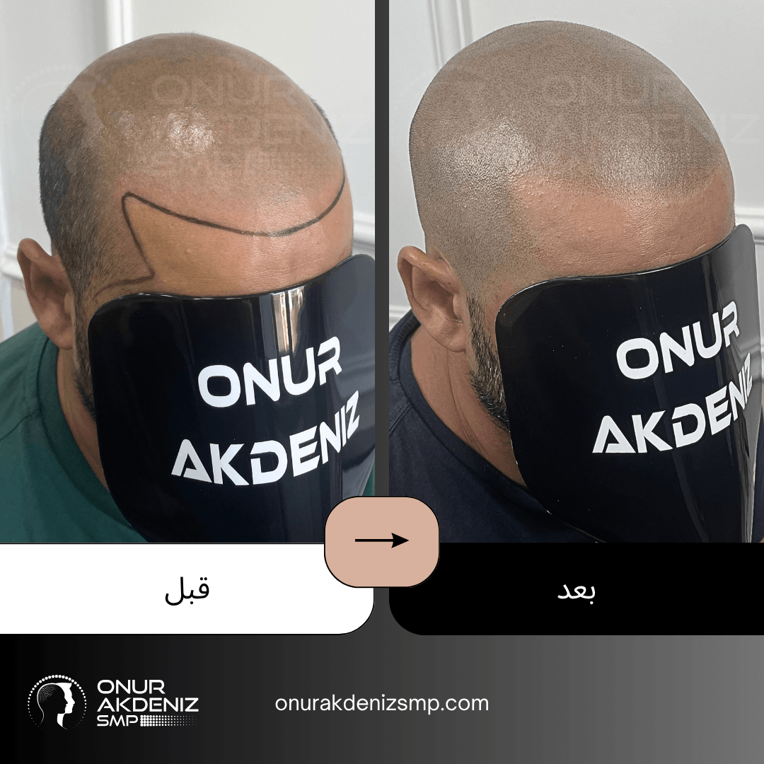 تصبغ فروة الرأس المجهري قبل وبعد للحصول على مظهر الشعر المحلوق مع أونور أكدينيز 145