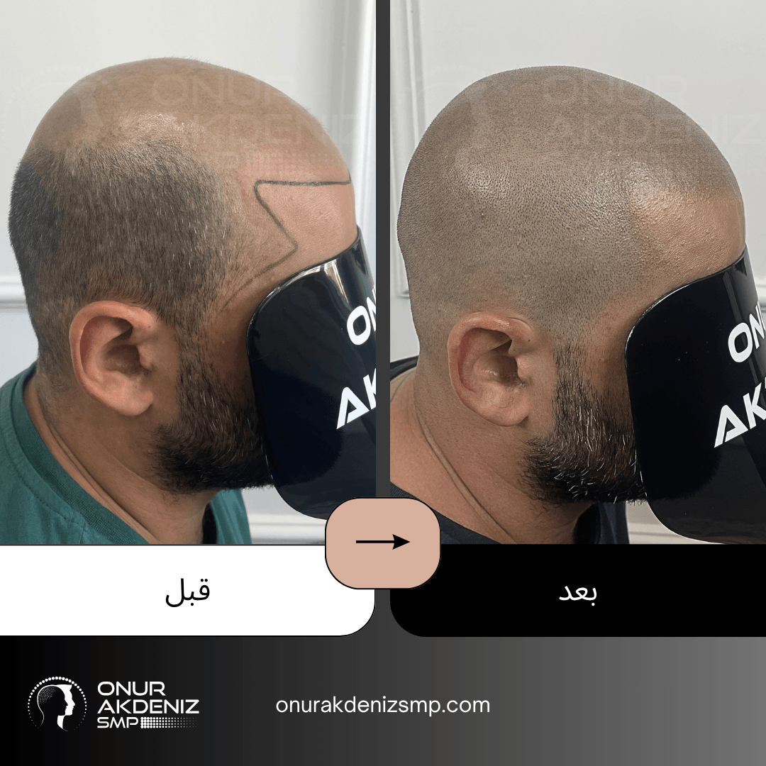 تصبغ فروة الرأس المجهري قبل وبعد للحصول على مظهر الشعر المحلوق مع أونور أكدينيز 147