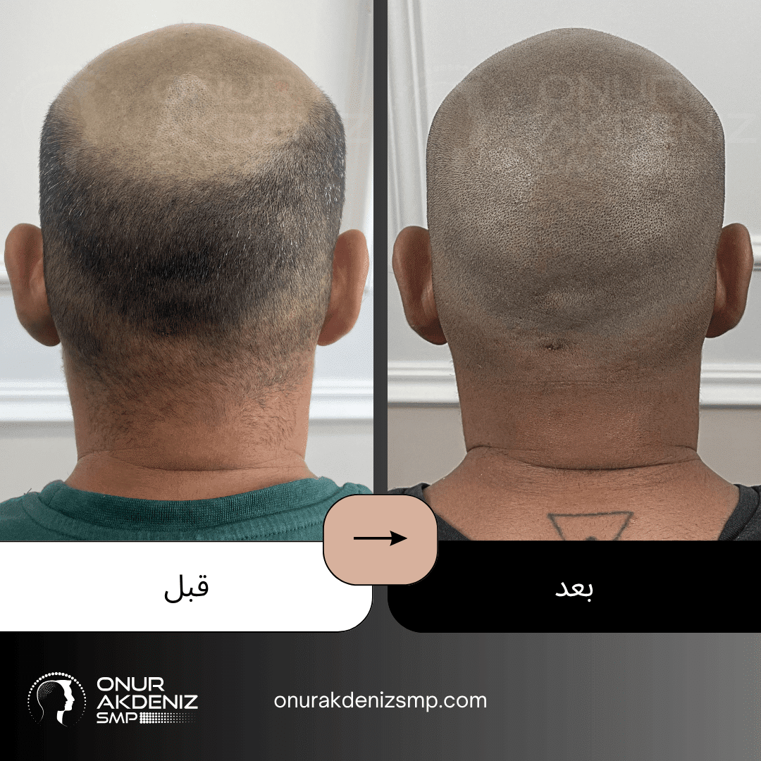 تصبغ فروة الرأس المجهري قبل وبعد للحصول على مظهر الشعر المحلوق مع أونور أكدينيز 149