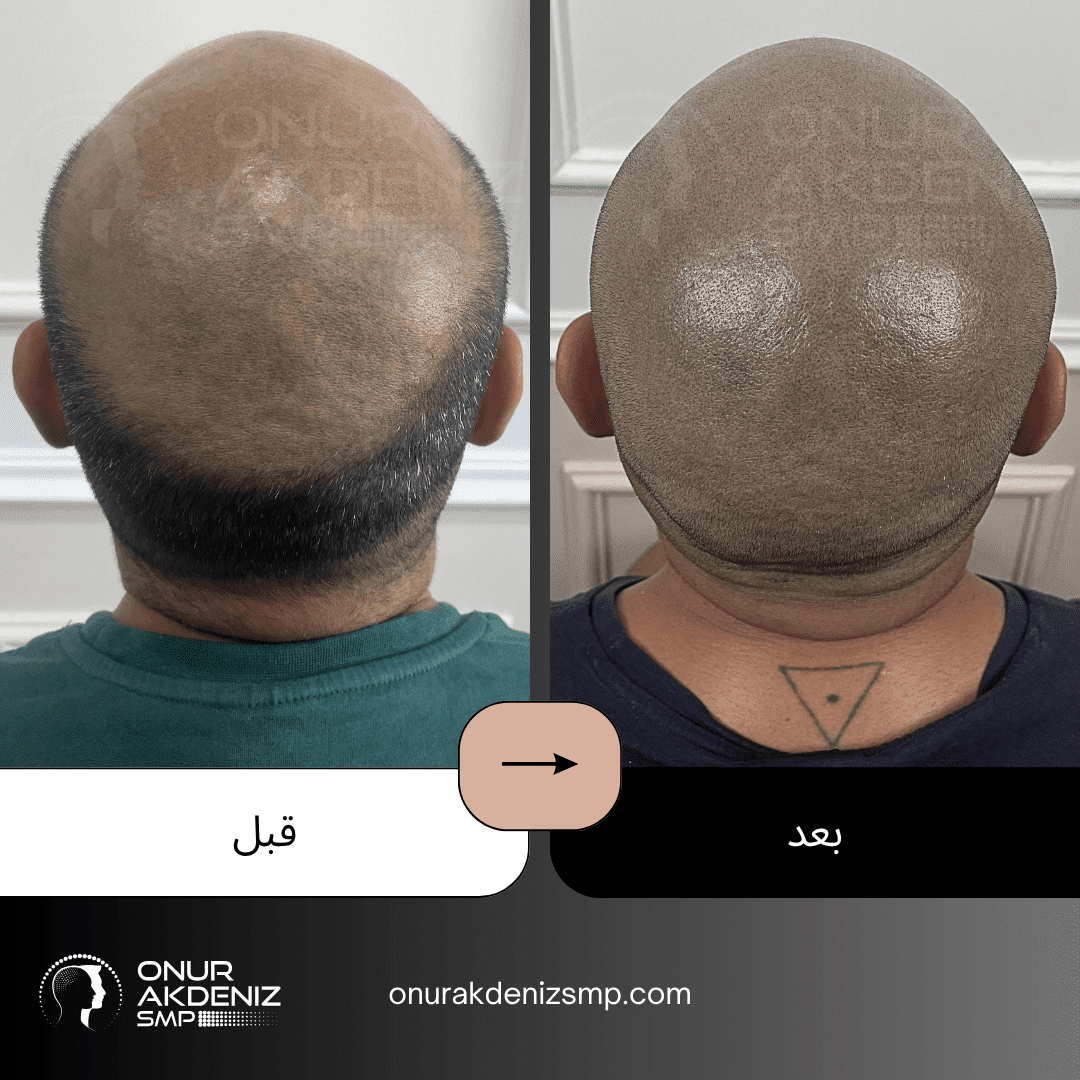 تصبغ فروة الرأس المجهري قبل وبعد للحصول على مظهر الشعر المحلوق مع أونور أكدينيز 150