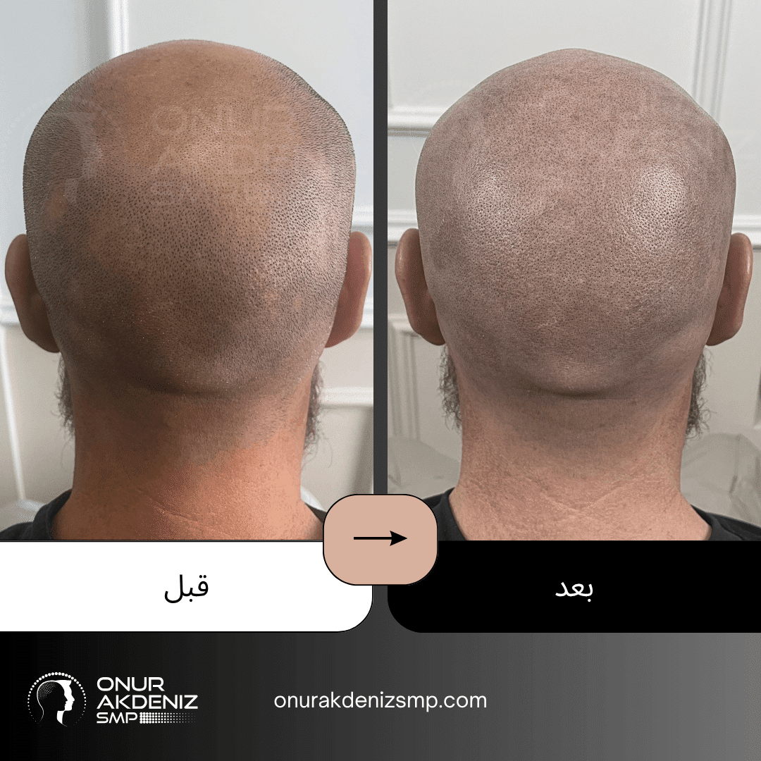 قبل وبعد الصبغ المجهري لفروة الرأس لمرضى داء الثعلبة في إسطنبول مع أونور أقدينيز SMP في تركيا 01