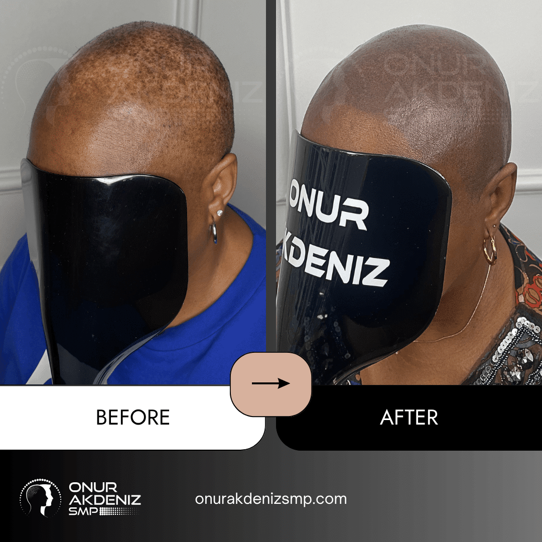 Before and After Scalp Micropigmentation for a Shaved Look African Female Onur Akdeniz SMP Istanbul Turkey 22