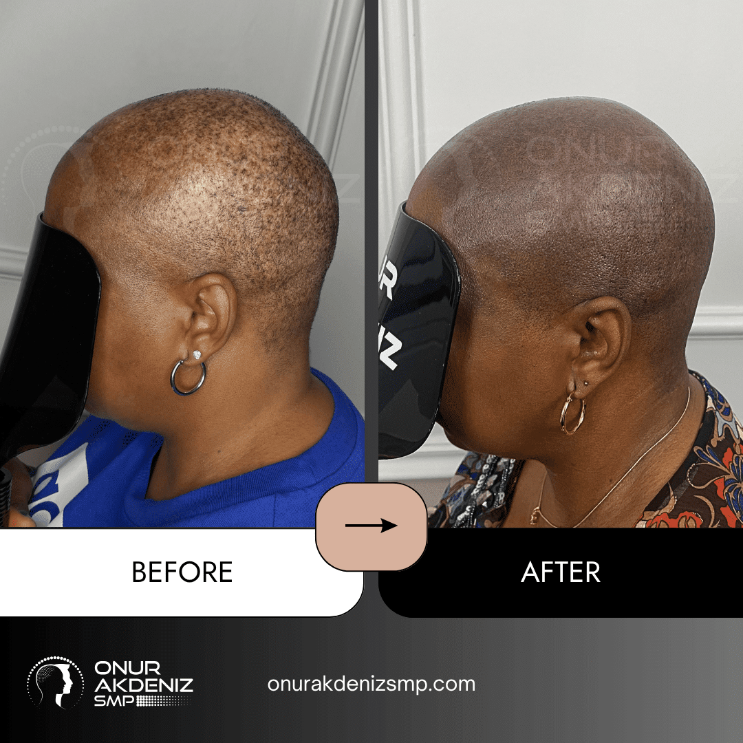 Before and After Scalp Micropigmentation for a Shaved Look African Female Onur Akdeniz SMP Istanbul Turkey 23
