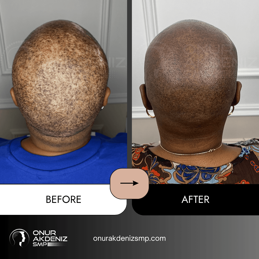 Before and After Scalp Micropigmentation for a Shaved Look African Female Onur Akdeniz SMP Istanbul Turkey 24