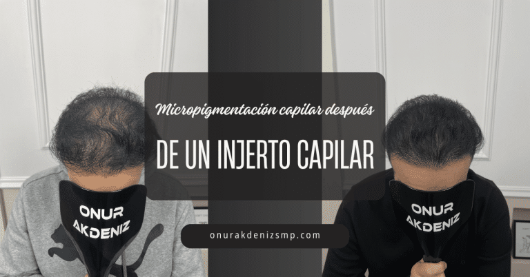 Micropigmentación capilar después de un injerto capilar