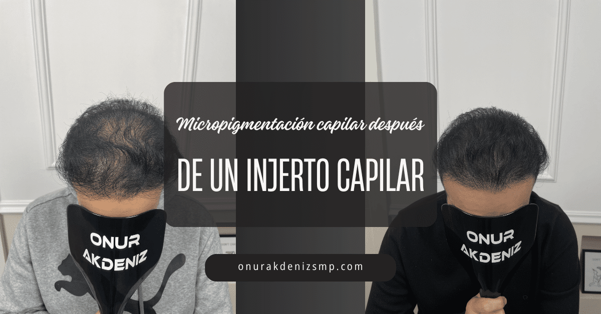 Micropigmentación capilar después de un injerto capilar