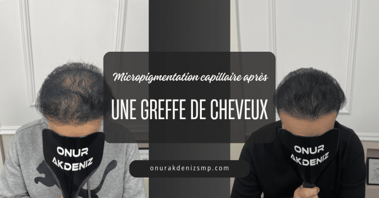 La micropigmentation capillaire après une greffe de cheveux