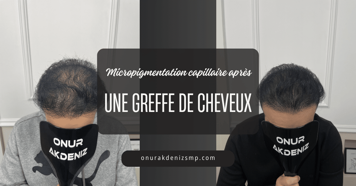 La micropigmentation capillaire après une greffe de cheveux