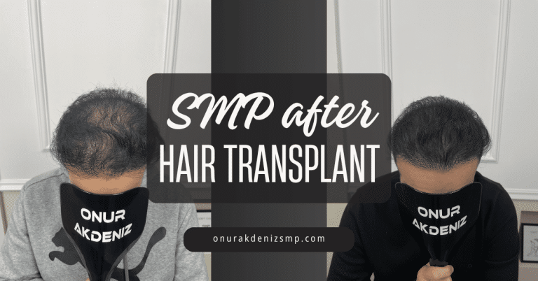 SMP after Hair Transplant