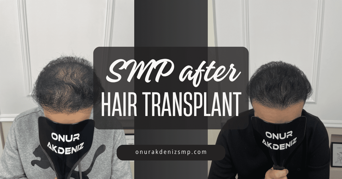 SMP after Hair Transplant