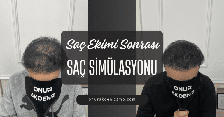 Saç Ekimi Sonrası Saç Simülasyonu