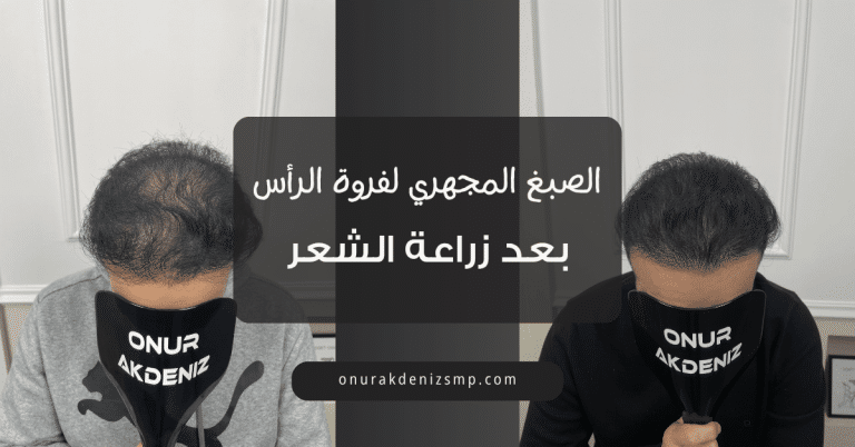 الصبغ المجهري لفروة الرأس بعد زراعة الشعر