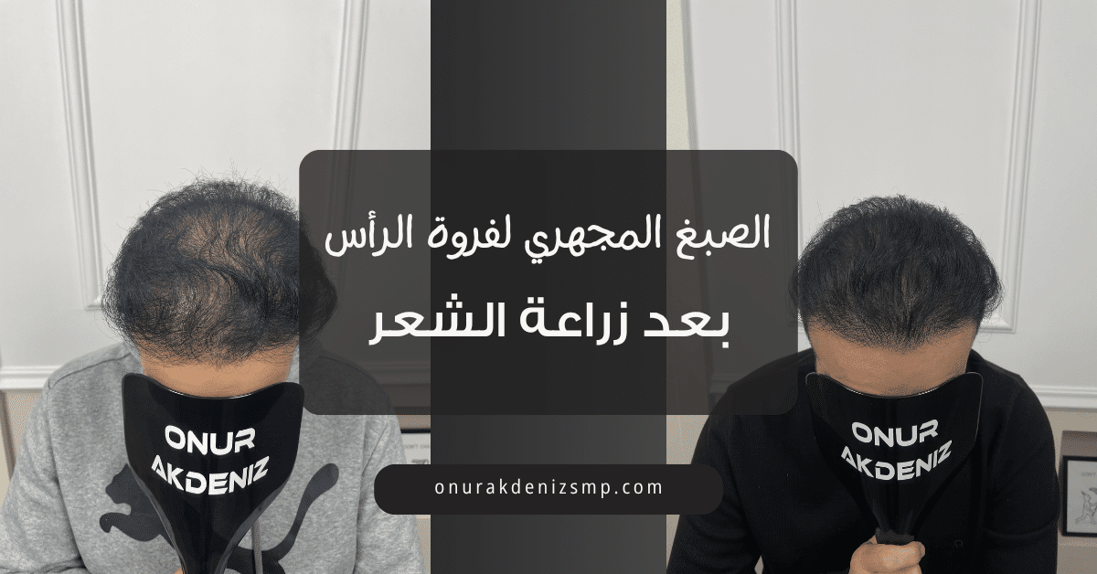 الصبغ المجهري لفروة الرأس بعد زراعة الشعر